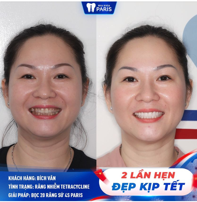 Răng nhiễm màu nặng, hình thể xấu  Giải pháp nào đẹp ngay kịp Tết?
