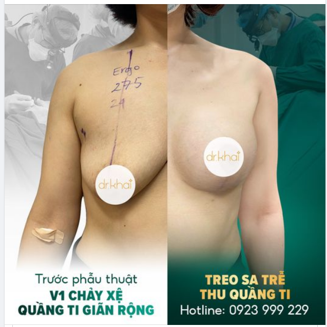 SO SÁNH KẾT QUẢ TREO SA TRỄ CẤP ĐỘ 3 VÀ THU QUẦNG TI CHO KHÁCH HÀNG SAU 3 THÁNG