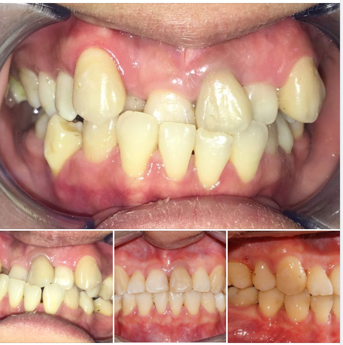 Có những ca niềng, bạn sẽ thấy sự thay đổi là đáng kinh ngạc!