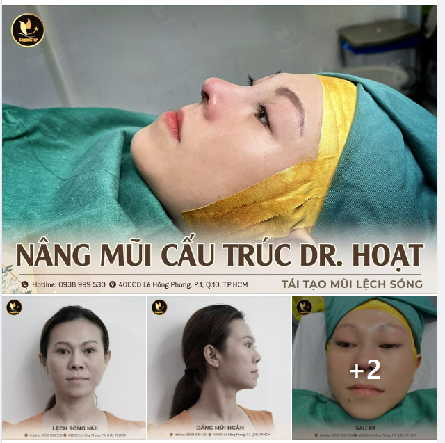NÂNG MŨI CẤU TRÚC DR. HOẠT – TÁI TẠO MŨI LỆCH SÓNG