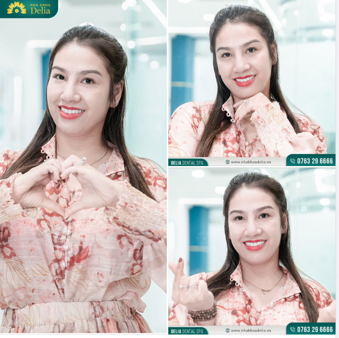 Chị Hải Hà sau 5 năm thẩm mỹ răng sứ tại Delia.