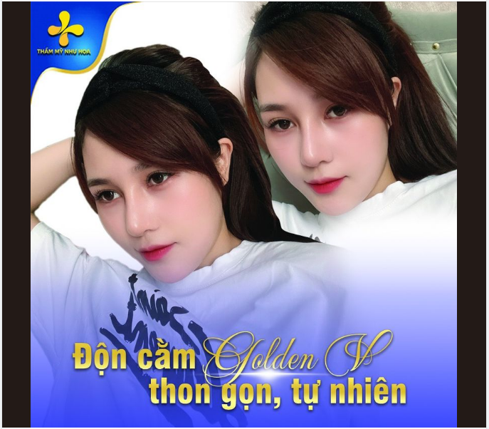 Cận cảnh cằm V-Line cực xinh sau khi thực hiện Độn cằm Golden V - Dr.Tống Hải.