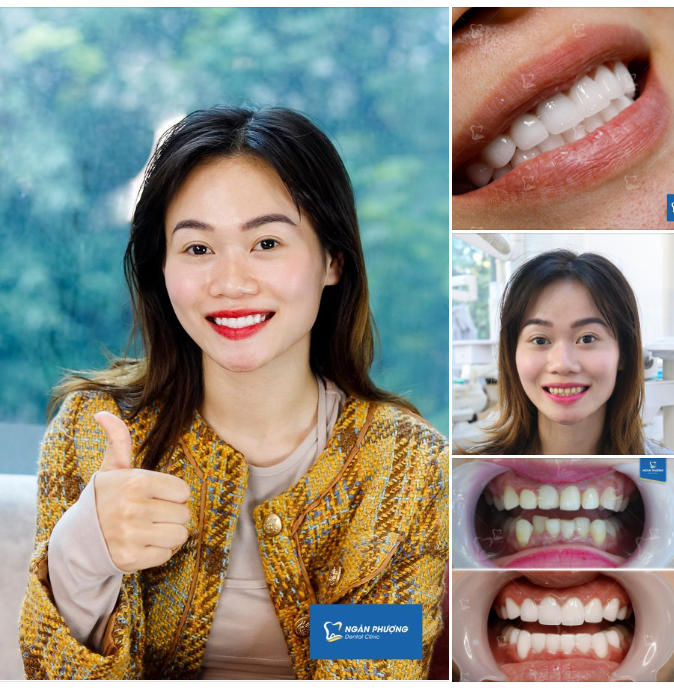 Răng sứ chị Hoàng Anh mới làm quá xinh đẹp đúng không cả nhà?