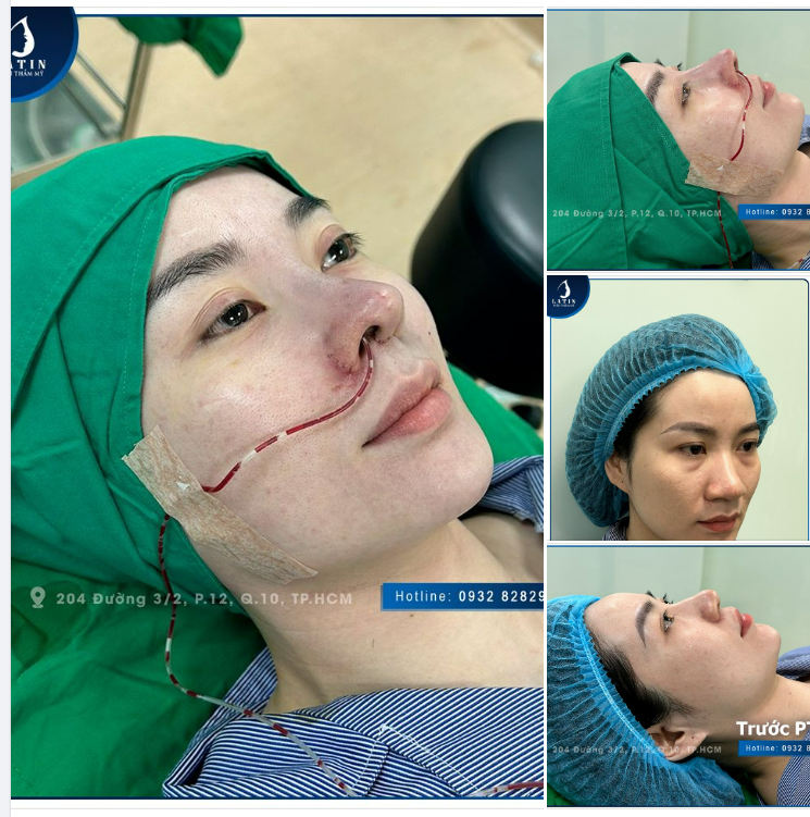 Tạm biệt mũi xấu chỉ sau 1 lần sửa mũi 