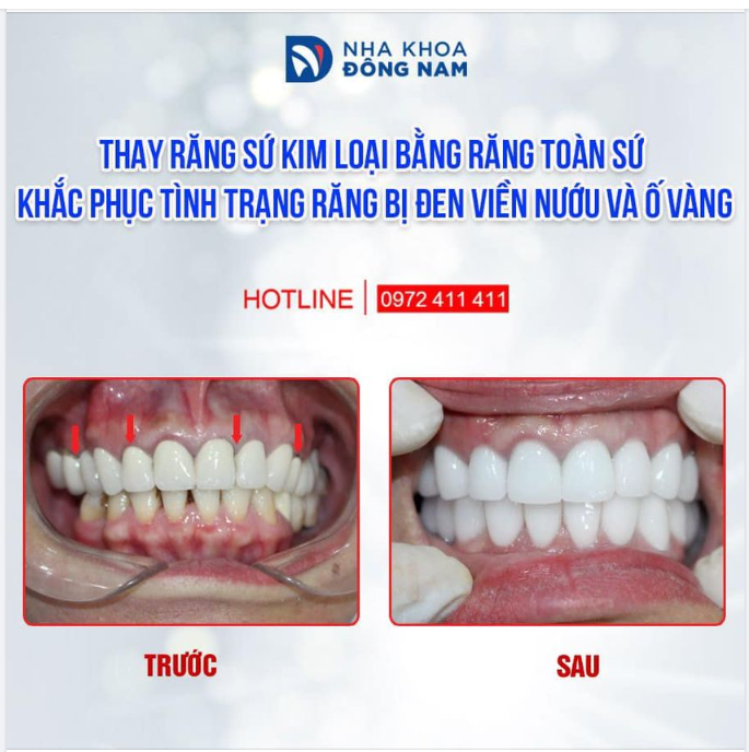 ĐÂY LÀ LÝ DO VÌ SAO BÁC SĨ LUÔN TƯ VẤN BỆNH NHÂN LỰA CHỌN RĂNG SỨ TOÀN SỨ KHI THẨM MỸ CẢ 2 HÀM