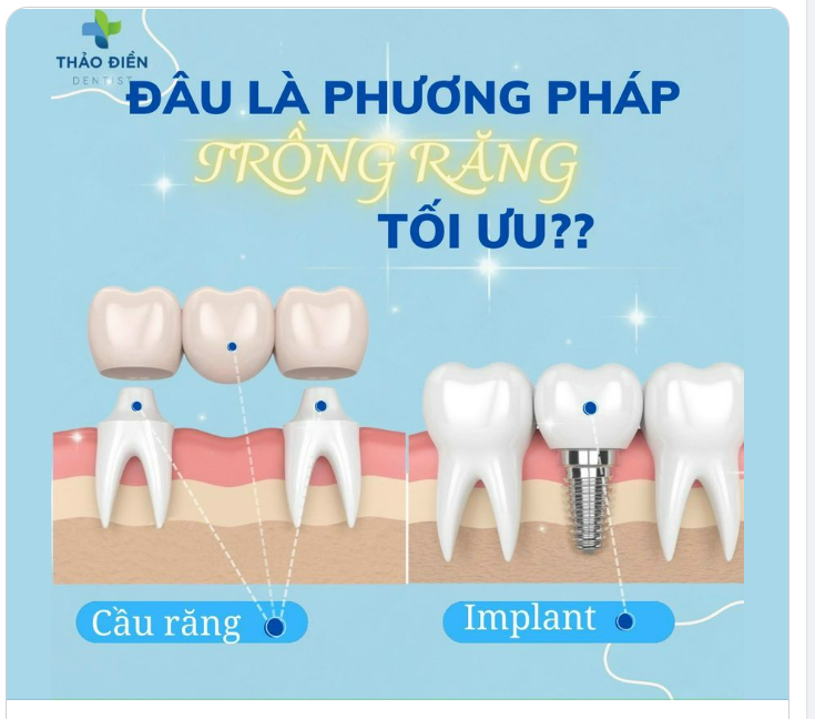 Implant hay Cầu răng sứ phương pháp trồng răng nào là tối ưu