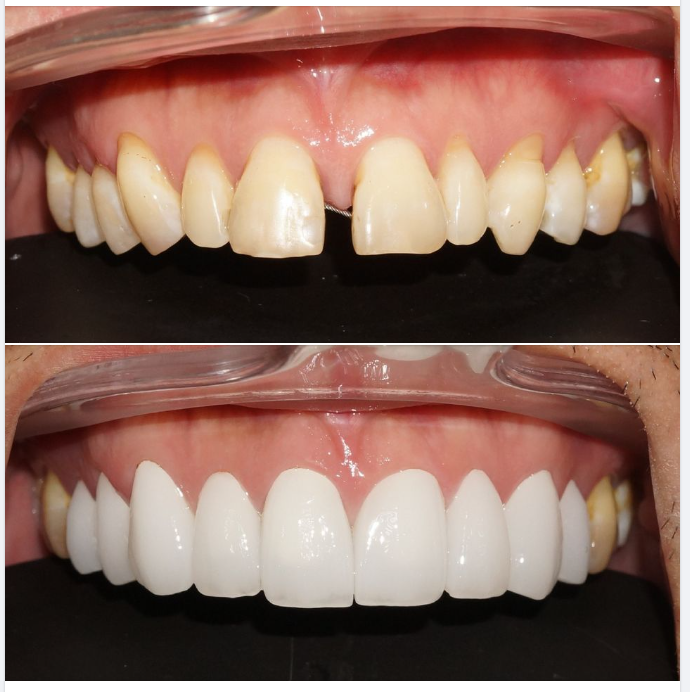  Một trường hợp làm sứ thẩm mỹ tại chi nhánh 149 Tôn Dật Tiên, do bác sĩ Hoài thực hiện!
