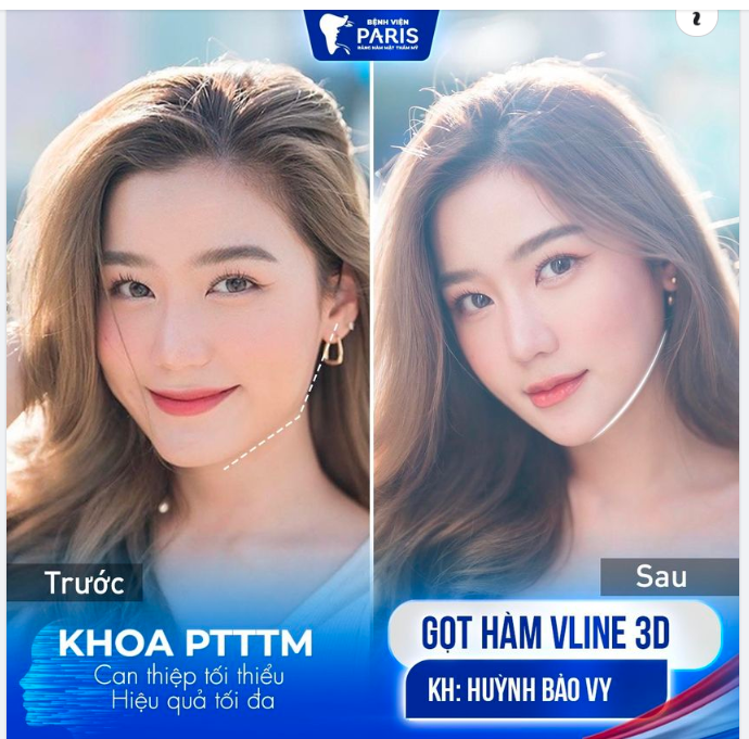 GỌT HÀM VLINE - 1 THÁNG THON GỌN, TỰ TIN ĐÓN TẾT