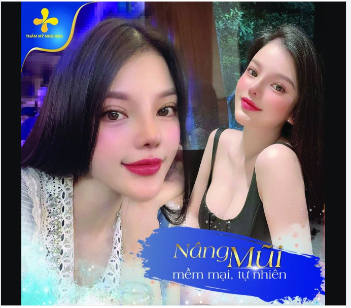 NHAN SẮC THĂNG HẠNG SAU KHI NÂNG MŨI SỤN MỸ
