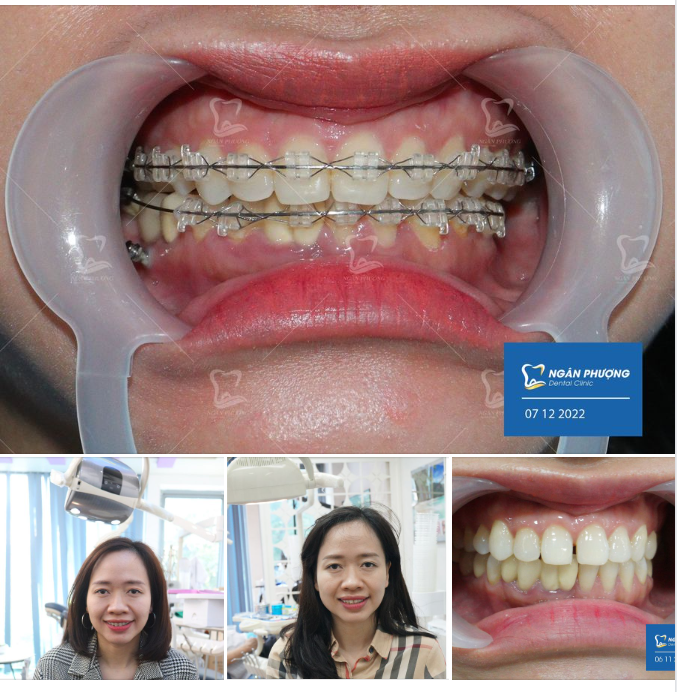 Đồng niềng ơi, có xin vía răng nhanh đều, nhanh đẹp thì "." ở phía dưới nhé ạ