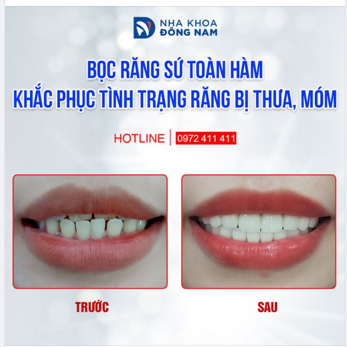 ĐÂY CHÍNH LÀ THỜI ĐIỂM TỐT NHẤT ĐỂ LÀM RĂNG ĐÓN TẾT, CHUẨN BỊ CHO CÁC BỮA TIỆC CUỐI NĂM