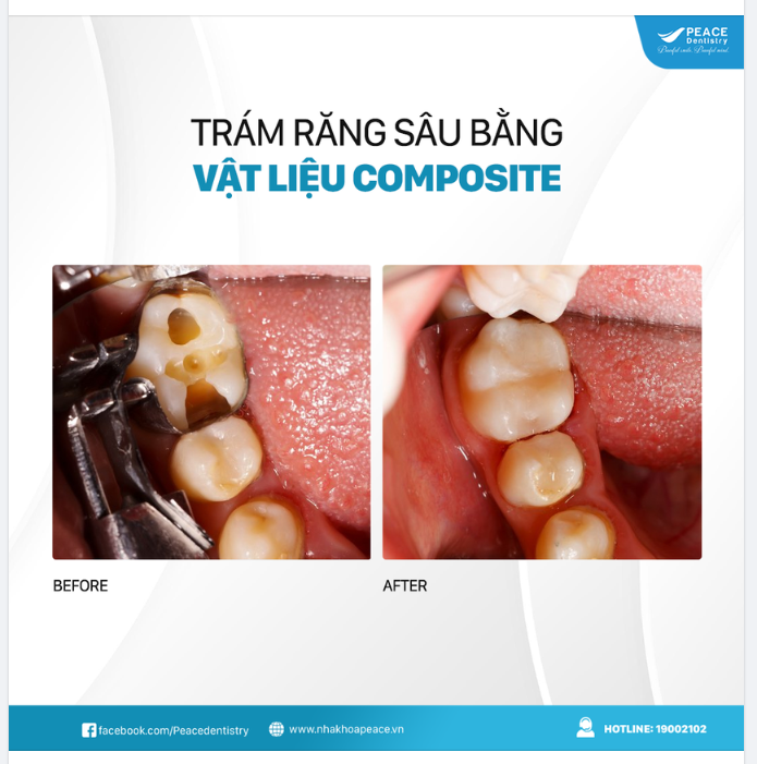 TRÁM RĂNG SÂU CÔNG NGHỆ HALOGEN - VẬT LIỆU COMPOSITE