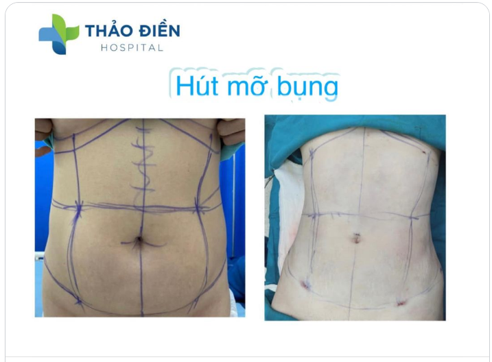 Sinh đẻ đã đau đến điên dại mà sau sinh để lại 1 ổ mỡ trên người muốn trầm cảm thêm 1 ngàn lần, đi tới đâu cũng bị nói bị chê mặc cảm lắm
