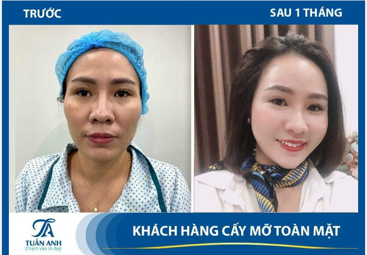Trẻ hoá toàn diện gương mặt. Tăng sinh collagen. Da căng mịn đầy sức sống