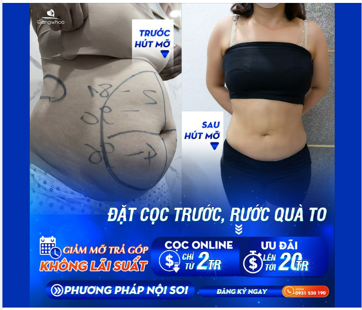 LIPO ULTRASOUND - THỜI GIAN NGHỈ DƯỠNG TRONG BAO LÂU?