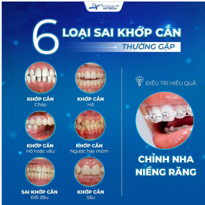 PHÂN LOẠI 6 DẠNG SAI LỆCH KHỚP CẮN VÀ HƯỚNG KHẮC PHỤC HIỆU QUẢ