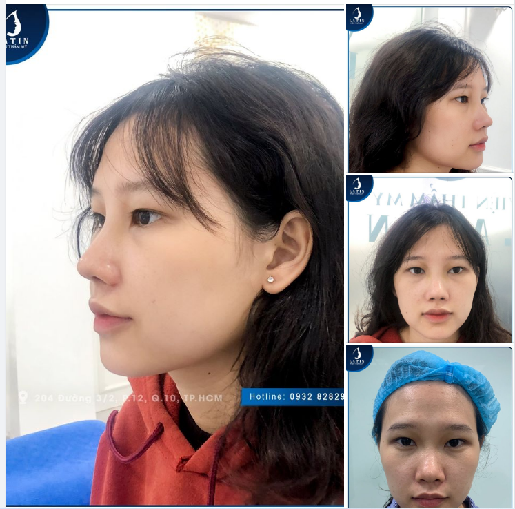 MŨI BÁN CẤU TRÚC 10 NGÀY NHƯ THẾ NÀO?