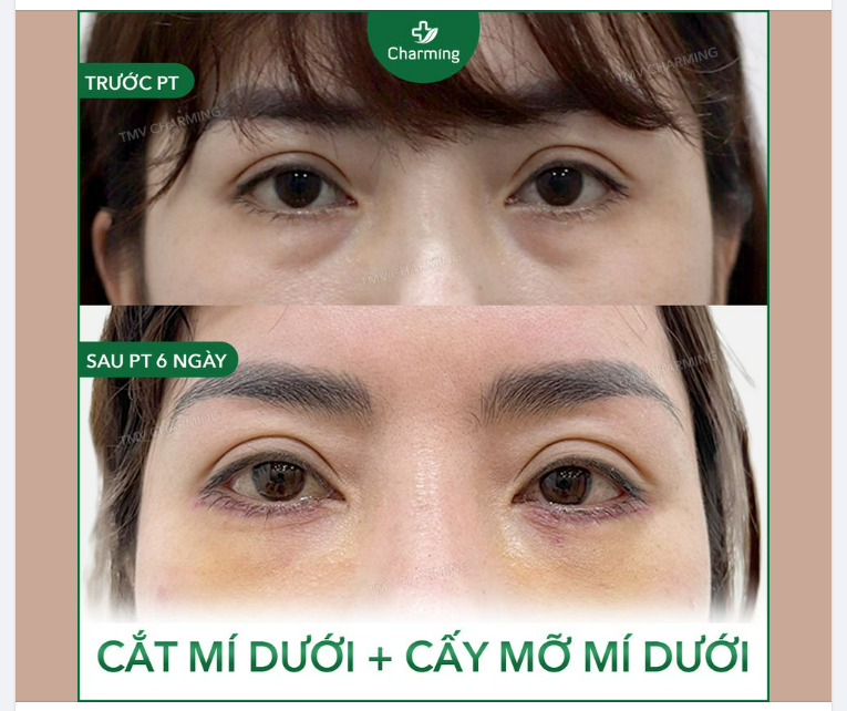 Có người mí dưới nhiều mỡ tạo thành bọng mắt thì cũng có những người lại thiếu mỡ mí dưới.