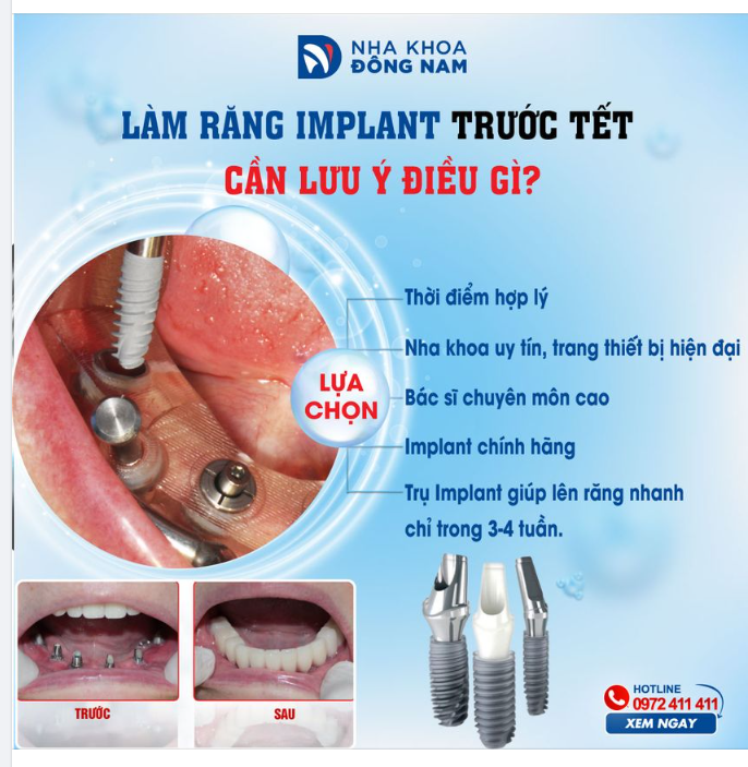 LÀM RĂNG IMPLANT TRƯỚC TẾT CẦN LƯU Ý ĐIỀU GÌ
