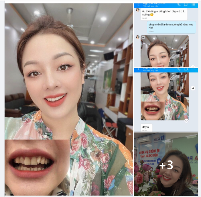 Niềng răng xong sẽ trở thành Mỹ Nhân???