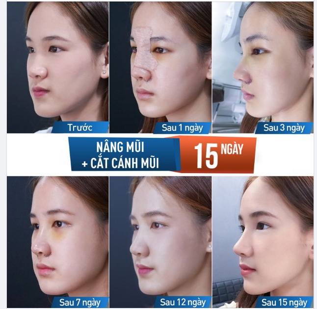 Quá trình hồi phục từng ngày sau nâng mũi + cắt cánh mũi