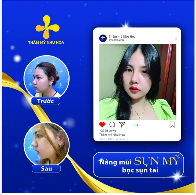 Mũi đẹp chuẩn Á Đông nhưng không kém phần sang chảnh, thời thượng.