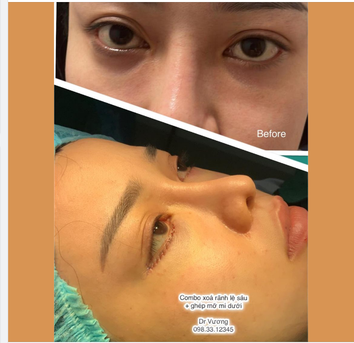 XỬ TRÍ VÙNG MÍ DƯỚI LÕM SÂU VỚI DR VƯƠNG