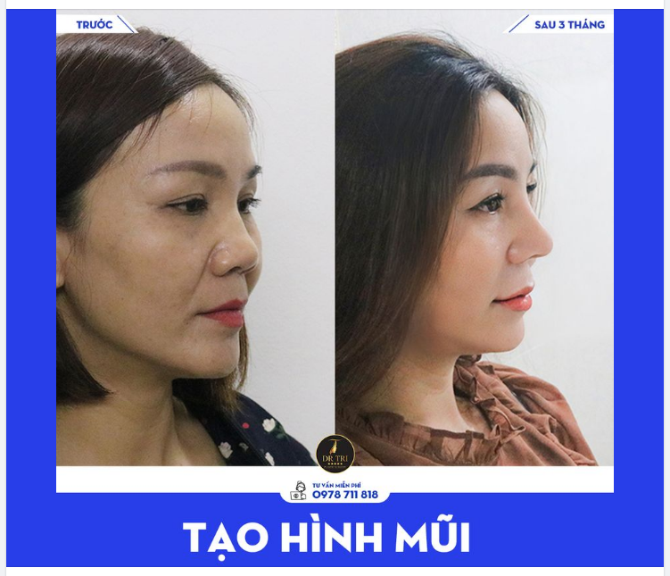 Khoe Góc Nghiêng Vừa Xinh Vừa Trẻ Của Chị Gái Tái Khám Tạo Hình Mũi