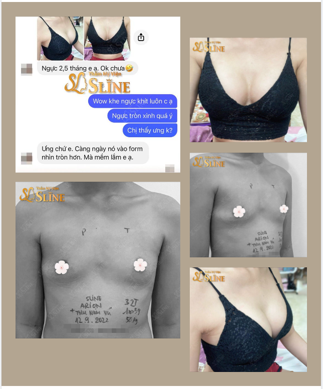 Feedback Nâng ngực  sau 2,5 tháng