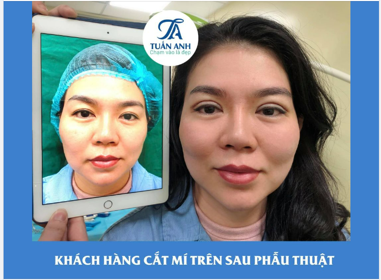 Bs ơi em muốn có đôi mắt 2 mí tự nhiên, đẹp đều nhau để Tết makeup cho xinh ạ
