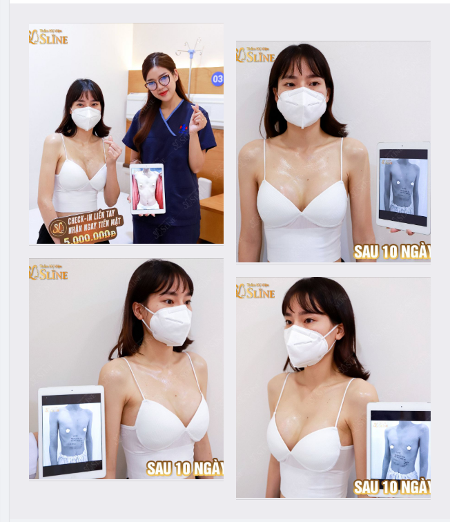 NÂNG NGỰC sau 10 ngày.
