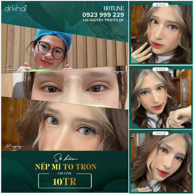 NHẬT KÝ TẠO HÌNH NẾP MÍ XINH SAU 1 THÁNG