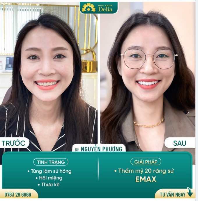 Chỉ 48H  Giải cứu thành công răng sứ hỏng