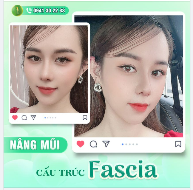FEEDBACK SAU 1 THÁNG NÂNG MŨI TẠI SAIGON VENUS