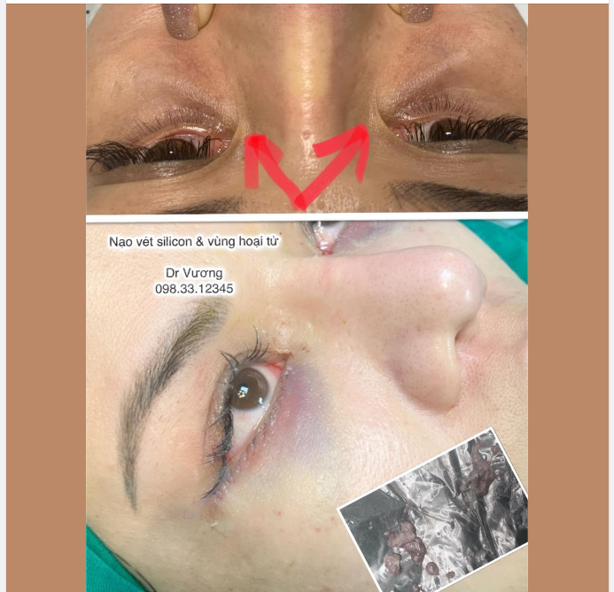 Nạo vét silicon  tổ chức hoại tử vùng mí dưới với Dr Vương !