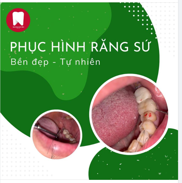 PHỤC HÌNH RĂNG SỨ - BỀN ĐẸP TỰ NHIÊN