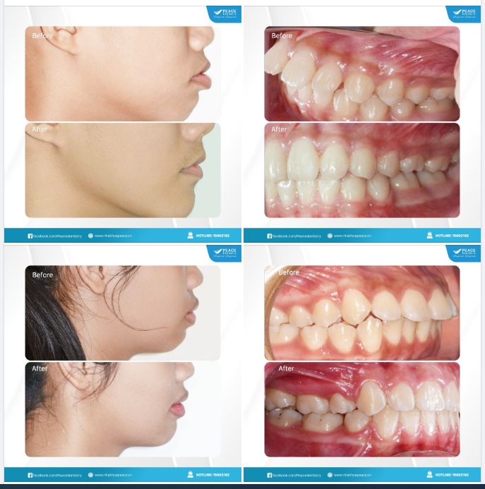 Nhan sắc thăng hạng nhờ niềng răng chỉnh hô
