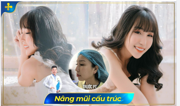 Bye bye chiếc mũi thô, gồ, kém xinh để chào đón dáng mũi mới SANG CHẢNH hơn!