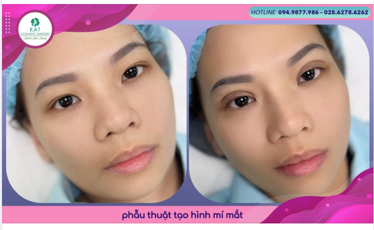 Chỉ với 30 phút phẫu thuật KAT đã giúp bạn tạm biệt đôi mắt không đều, sụp mí và trao lại một đôi mắt hai mí long lanh biết nói.