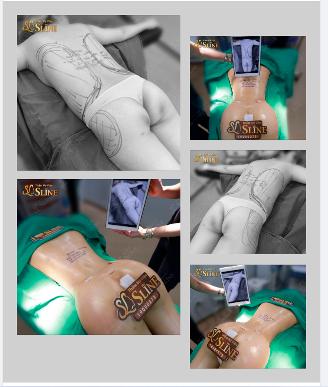HÚT MỠ SIẾT EO 360° CHÌA KHÓA CHO BODY VẠN NGƯỜI MÊ.