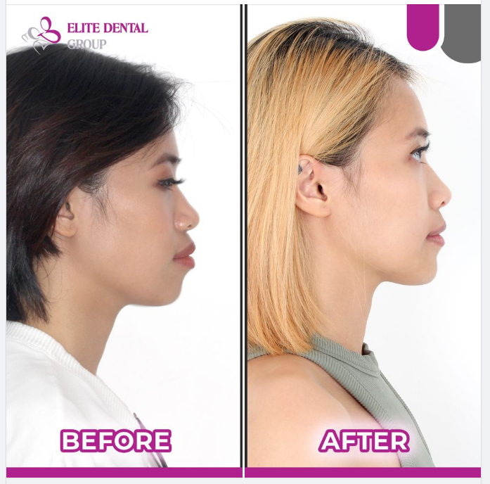 Giảm hô, cải thiện góc mặt nghiêng, thẩm mỹ môi 100% sau niềng răng