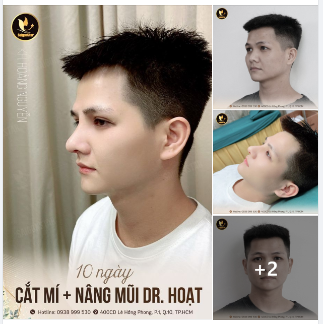 10 NGÀY CHUẨN HOT BOY: NÂNG MŨI + CẮT MÍ