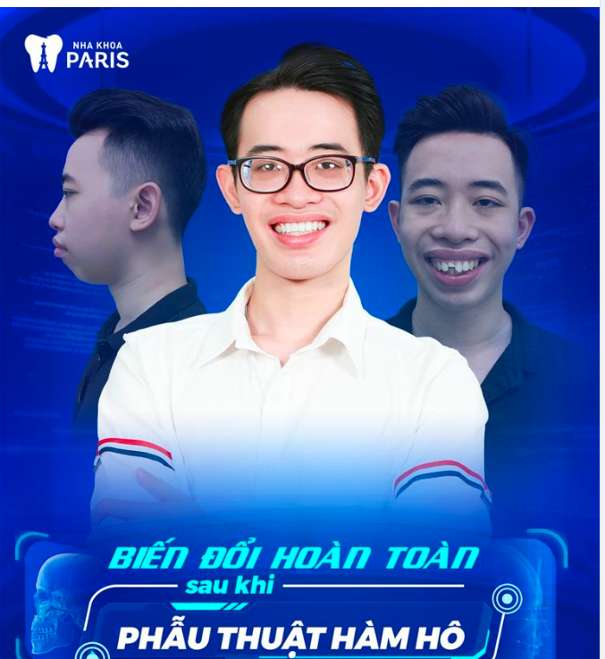 Phẫu thuật hàm hô - Mặt cân đối đẹp tự nhiên