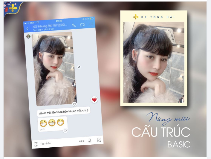 Feedback sau 1 tháng nâng mũi cấu trúc basic
