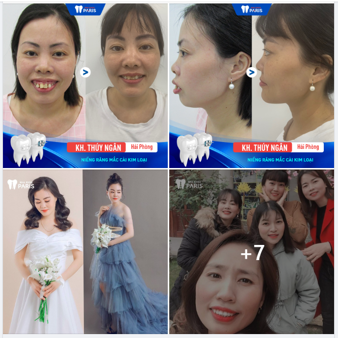Chúc mừng chị Thúy Ngân đã vượt qua hành trình đeo niềng để có được nụ cười tự tin và xinh đẹp hiện tại.