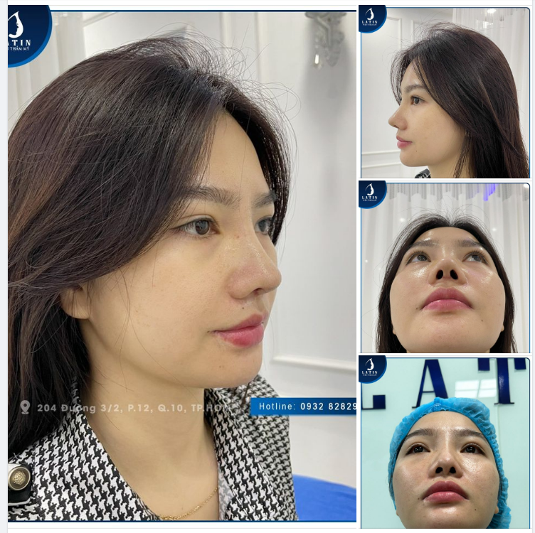 Hành trình đi tìm dáng mũi đẹp của bạn khách hàng đã từng nâng mũi hỏng