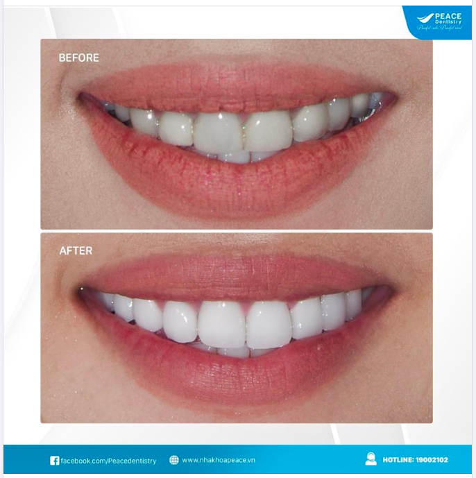 Thay răng sứ cũ “đổi” diện mạo mới cho răng