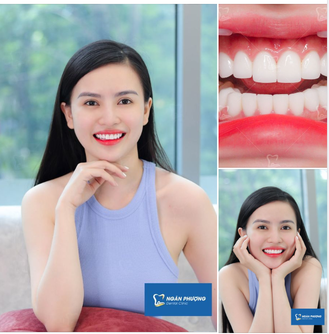 Hình tái khám sau 1 năm của chị đẹp Bắc Ninh