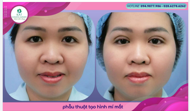 “ Giải pháp cho đôi mắt sụp míowr người trẻ tuổi “