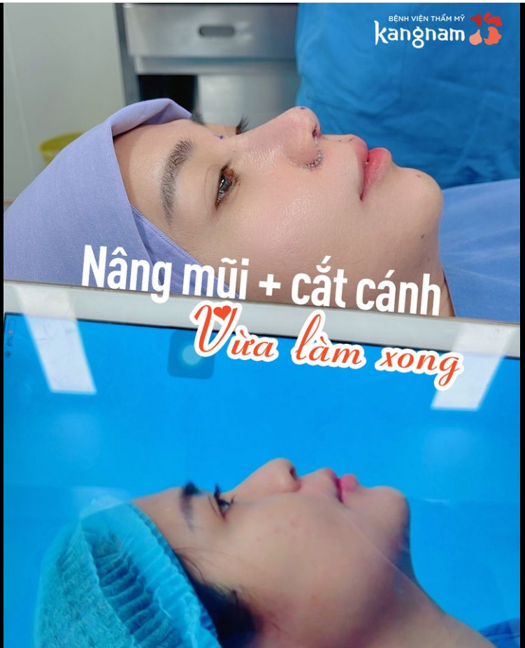 Thả nhẹ chiếc ảnh nâng mũi + cắt cánh mũi vừa xong